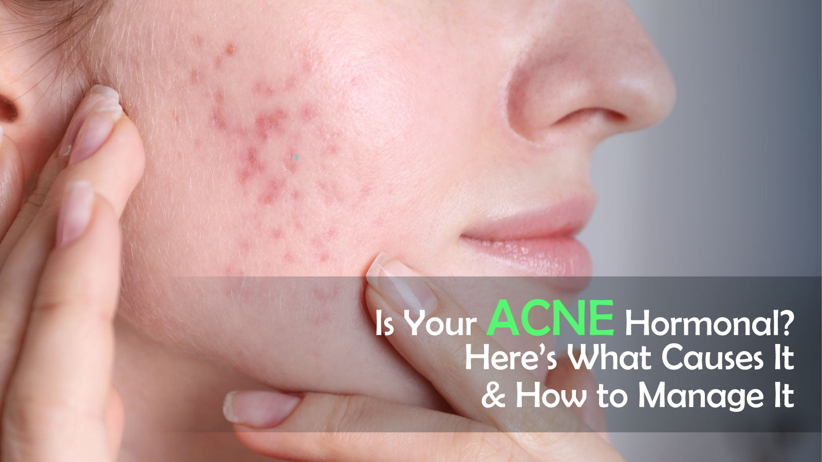Is Your Acne Hormonal? Here’s What Causes It & How to Manage It