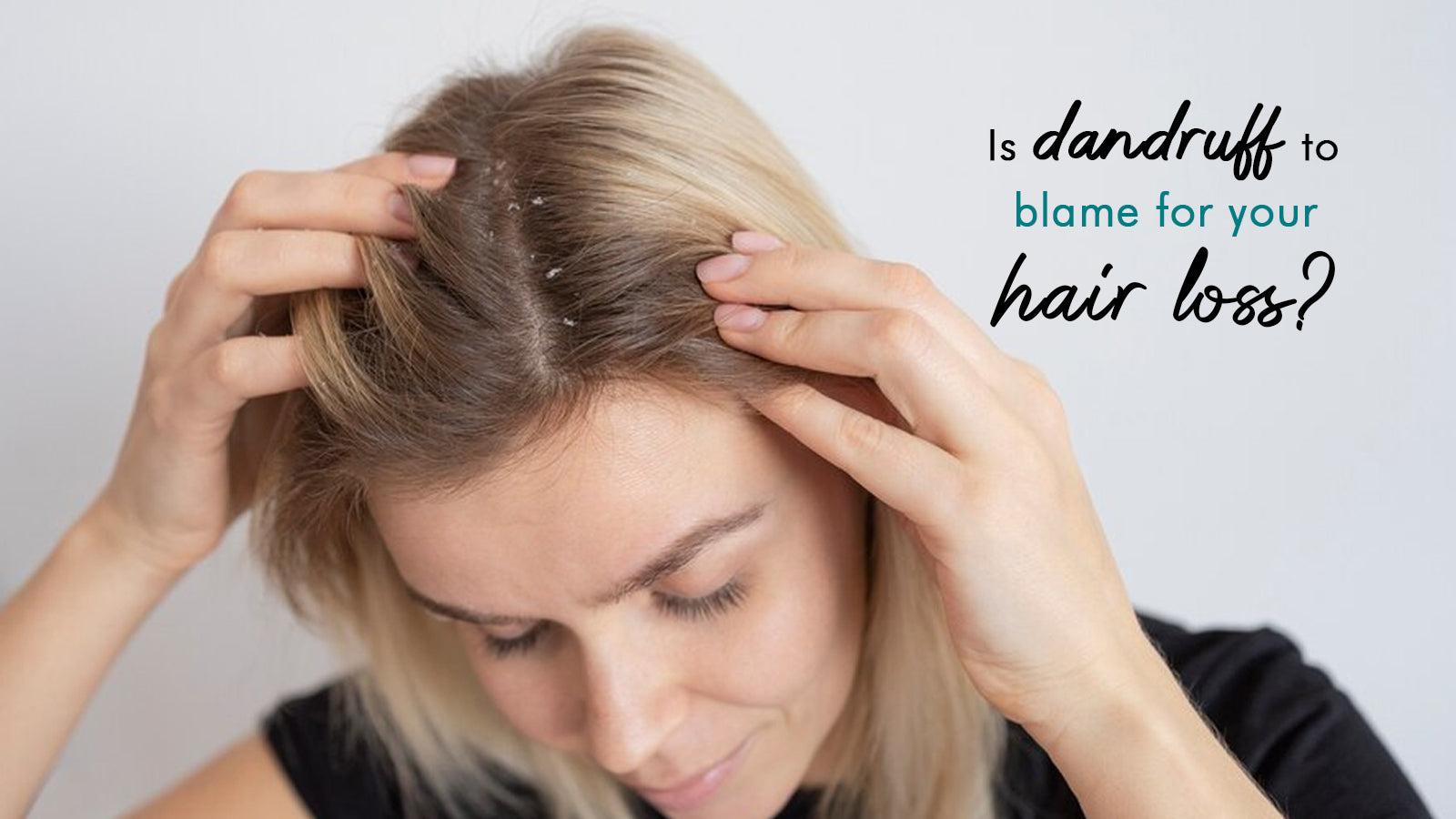 Is dandruff to blame for your hair loss?